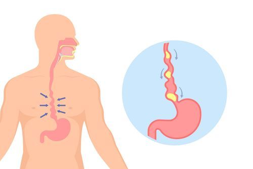 Symptoms of Achalasia: Diagnostic Procedures 